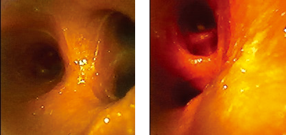 USHIO Theia-40 系列內(nèi)窺鏡實(shí)際效果 USHIO Theia-40 系列內(nèi)窺鏡實(shí)際效果